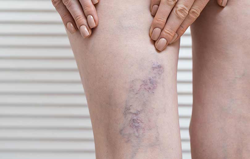 Varicose veins can affect women in the second and third trimesters of pregnancy.