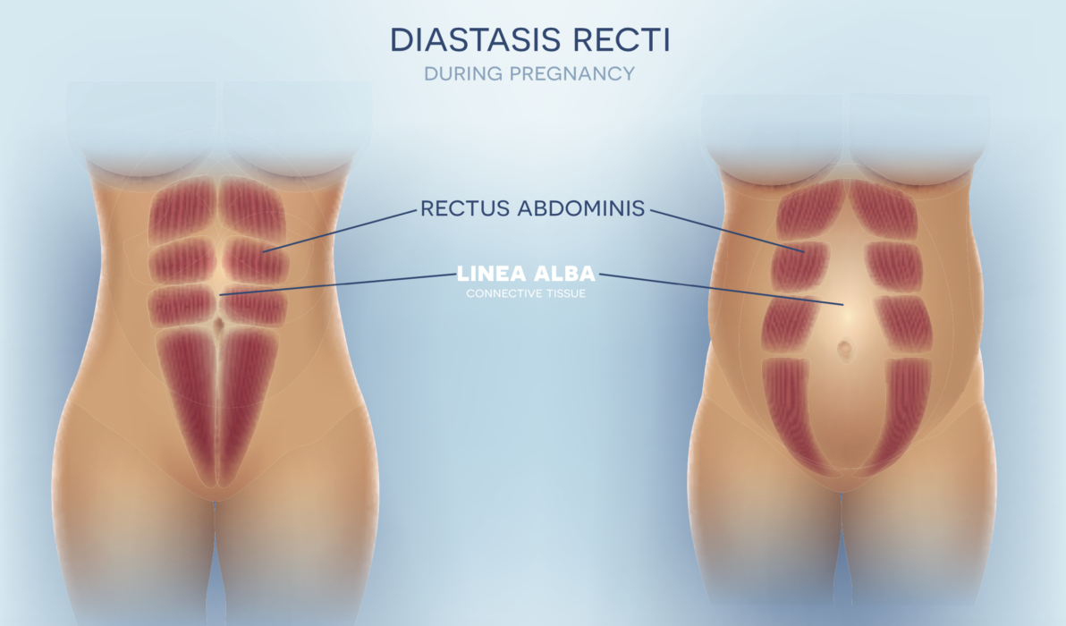 The truth about your postpartum body_Diastasis Recti